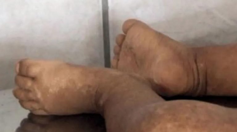 Laudo de bebê indígena estuprada no Acre será entregue à polícia nesta semana