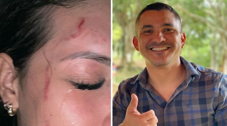 Mulher fica com rosto arranhado após suposta agressão por dentista no Seringal Bier