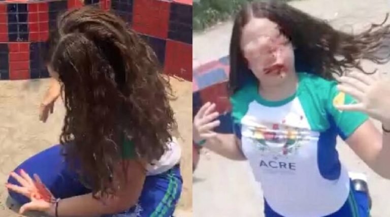 Aluna tem boca rasgada durante briga em praça pública e vai parar no hospital