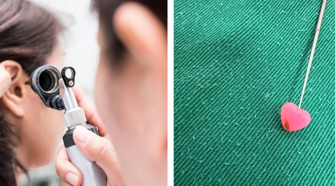 No Acre, médico retira uma miçanga em formato de coração de dentro do ouvido de criança