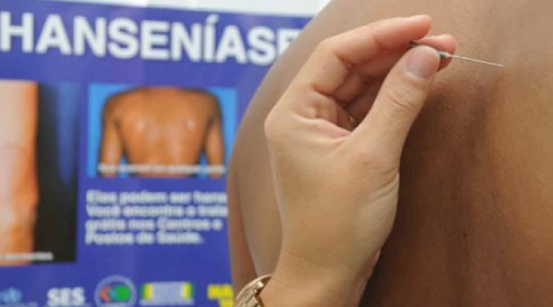 Brasil é o segundo país com mais notificações de hanseníase no mundo