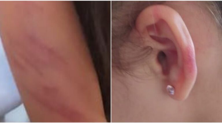 Menina de cinco anos demora a tomar café da manhã e é agredida com cinturão pelo pai