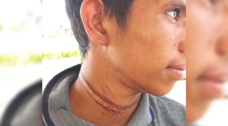 Adolescente quase é degolado ao tentar laçar vaca em Sena Madureira