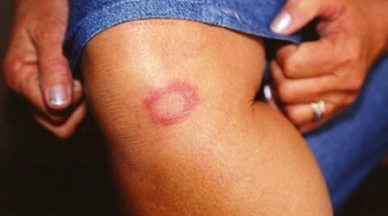 Hanseníase: Acre registrou mais de 40 casos da doença entre 2018 e 2022