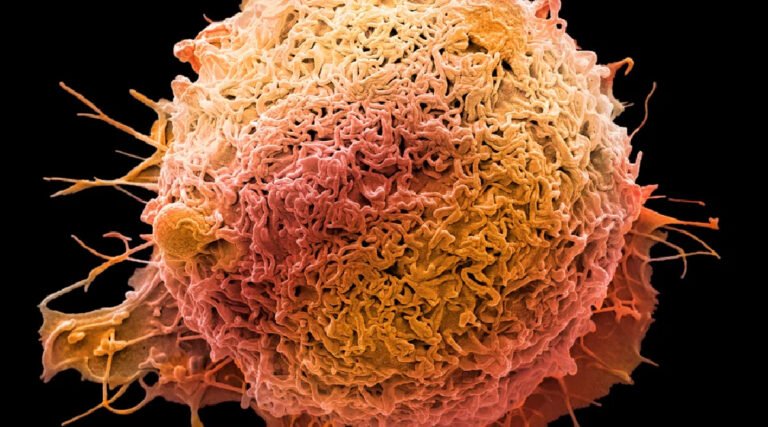 Médicos alertam para o ‘assustador’ crescimento do câncer colorretal em pessoas de até 50 anos