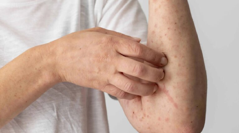 Acre registra quase 480 casos de febre Oropouche e 1 óbito em 2024, diz Saúde