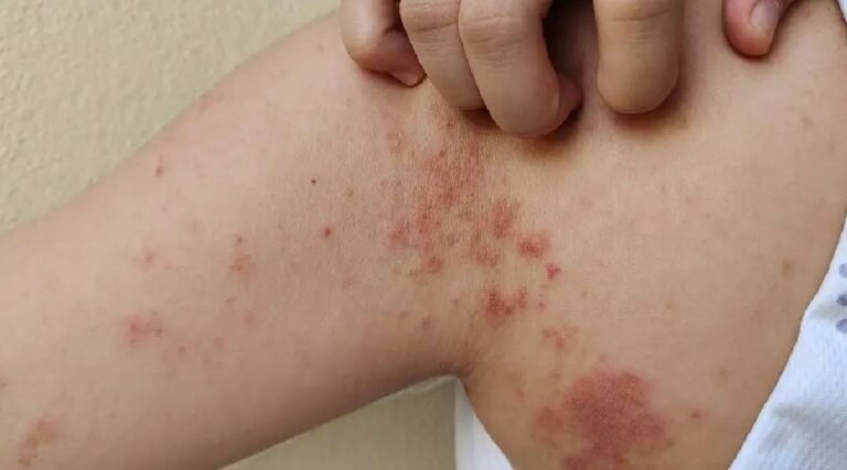 Quase 20 pessoas estão em tratamento contra a hanseníase em cidade do Acre: “Doença tem cura”