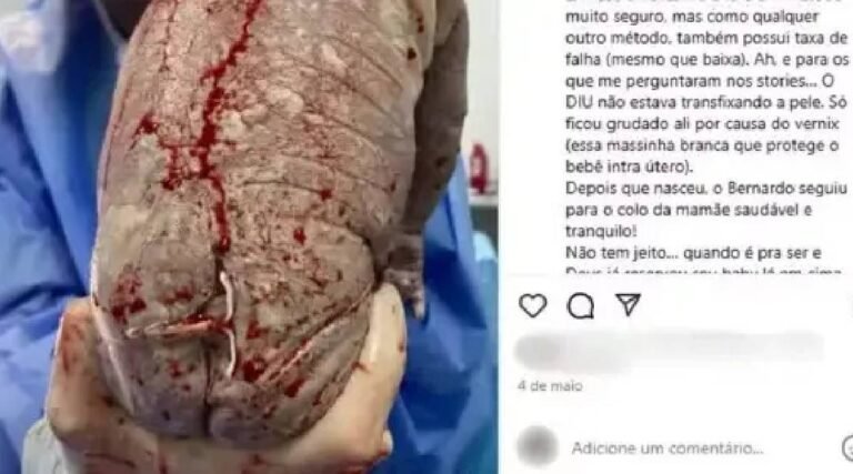 Mulher engravida com DIU e bebê nasce com dispositivo nas costas