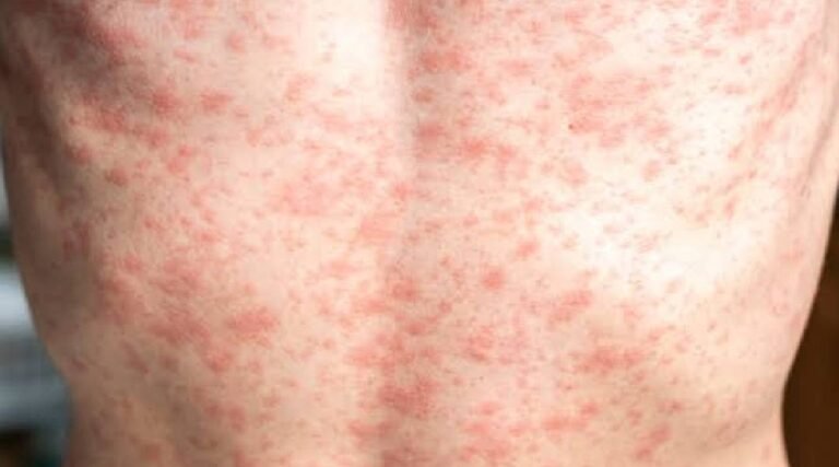 Acre mantém sete casos suspeitos de sarampo em investigação; Cruzeiro do Sul tem cinco notificações