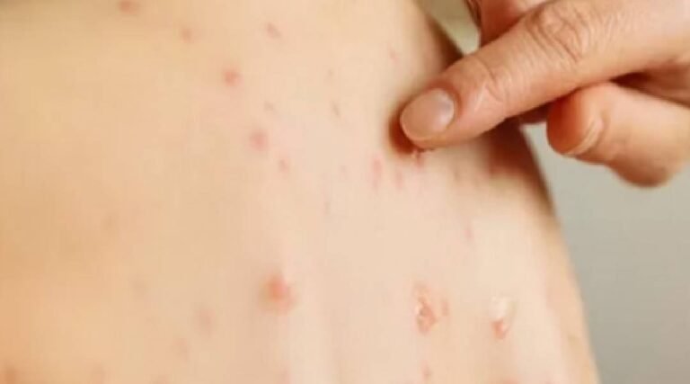 Caso suspeito de sarampo é descartado em Cruzeiro do Sul, mas autoridades reforçam alerta para vacinação