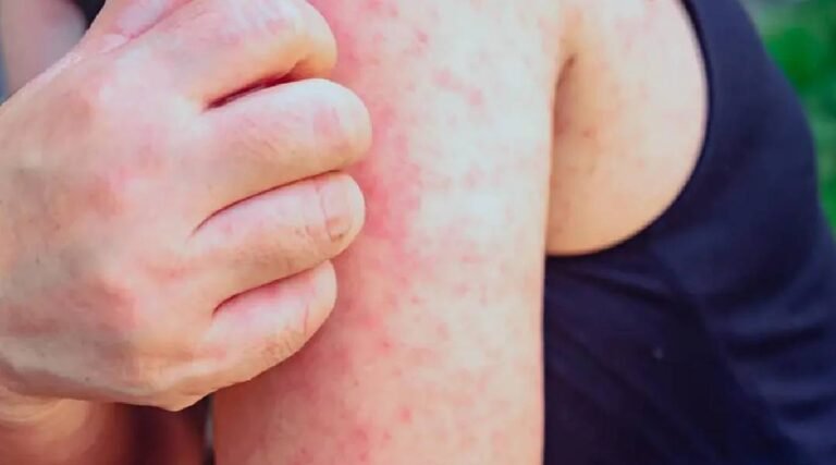 Sarampo: 11 casos estão sob investigação no Acre; 16 já foram descartados