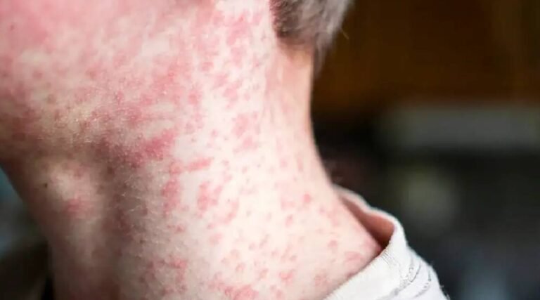 Acre segue sem sarampo, mas já notificou 35 casos suspeitos da doença