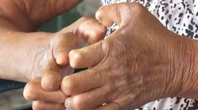 Acre regulamenta lei que reconhece vítimas de isolamento compulsório por hanseníase