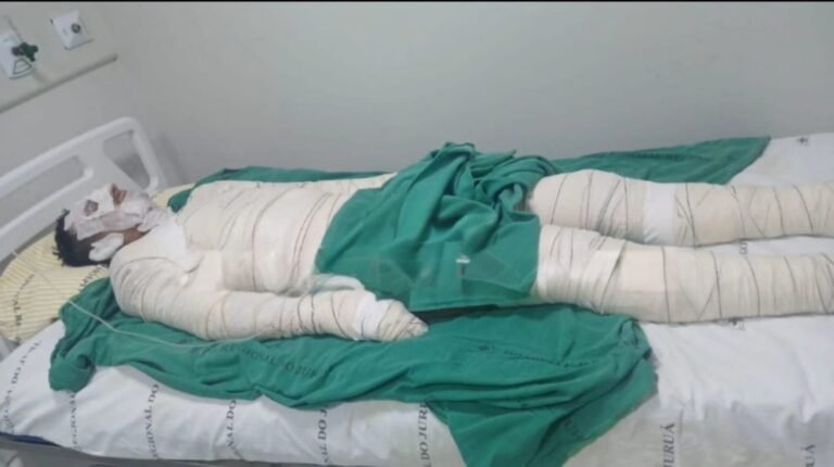 Homem sofre queimaduras graves após incêndio em embarcação no Rio Juruá, em Cruzeiro do Sul