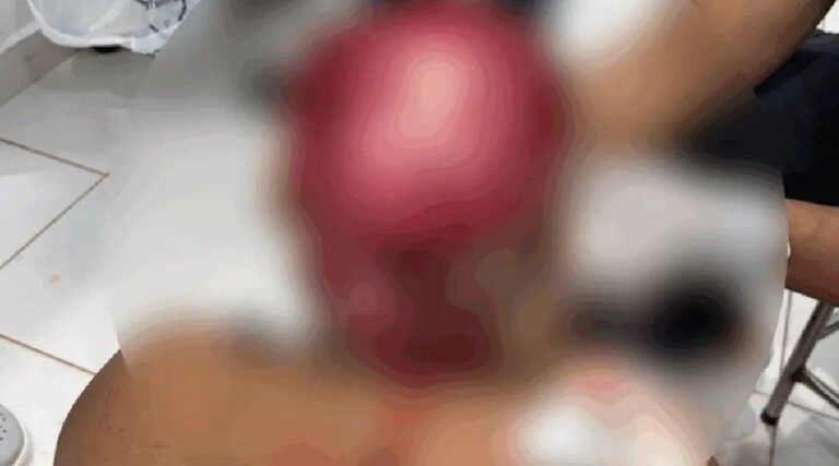 Jovem indígena tem couro cabeludo arrancado ao operar draga no Rio Acre