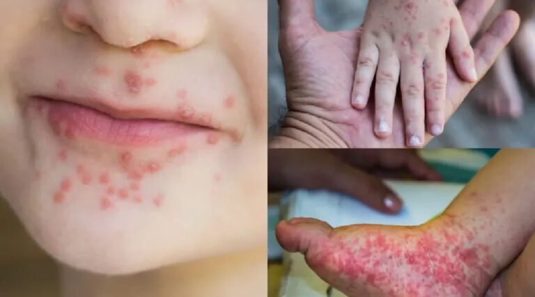 Mais de 170 crianças são diagnosticadas com doença mão-pé-boca na capital e Saúde entra em alerta