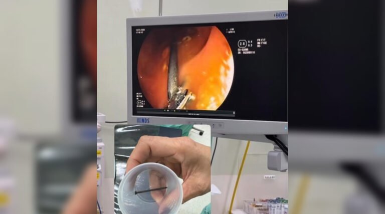 Menino de 3 anos passa por procedimento no Hospital do Juruá após engolir prego