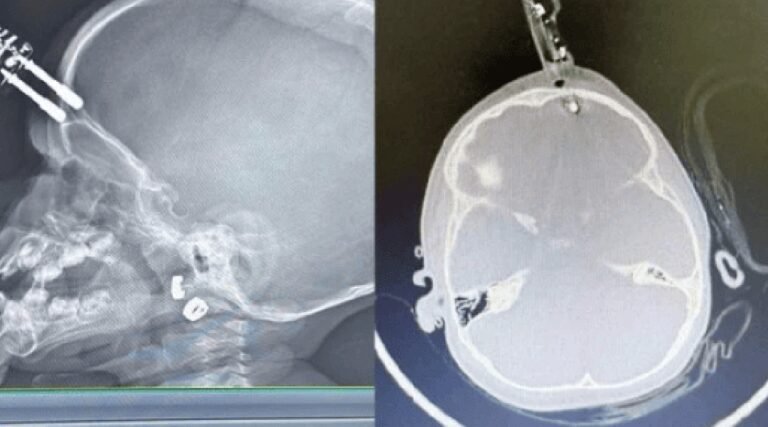 Carregador perfura crânio de criança de 1 ano após queda em casa