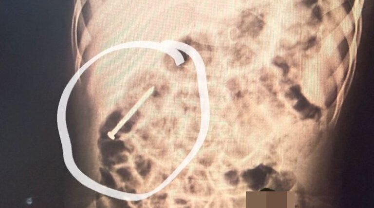 Menino de 2 anos engole prego e segue internado no Hospital do Juruá