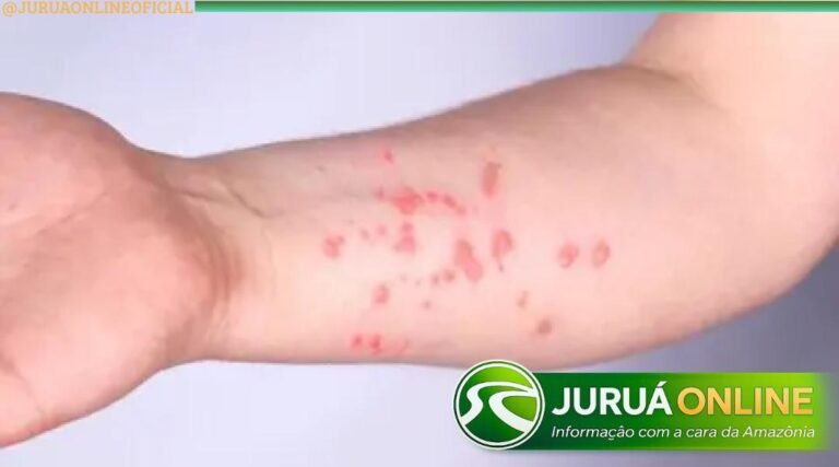 Sobe para quatro os casos de Mpox em Porto Velho