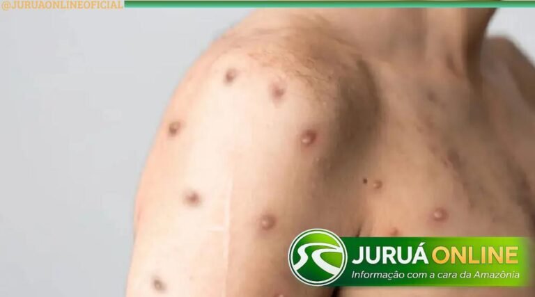Rio Branco registra primeiro caso suspeito de Mpox e Vigilância acompanha