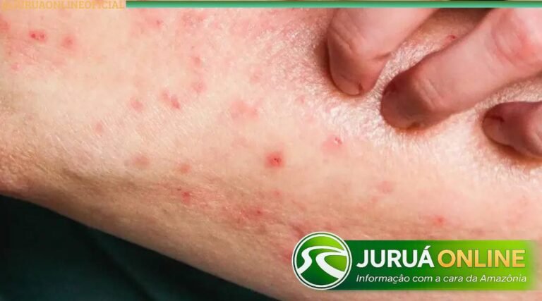 Secretaria Municipal de Saúde confirma resultado negativo para Mpox