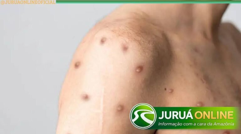 Caso suspeito de Mpox no Acre é descartado após resultado laboratorial, diz secretário de Saúde