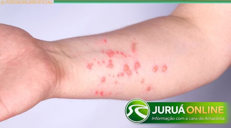 Acre registra primeiro caso de Mpox no interior; paciente está em isolamento