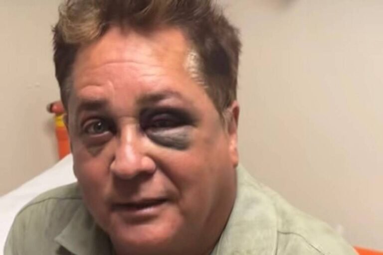 Leonardo sofre acidente durante pescaria e aparece com olhos roxos e inchados