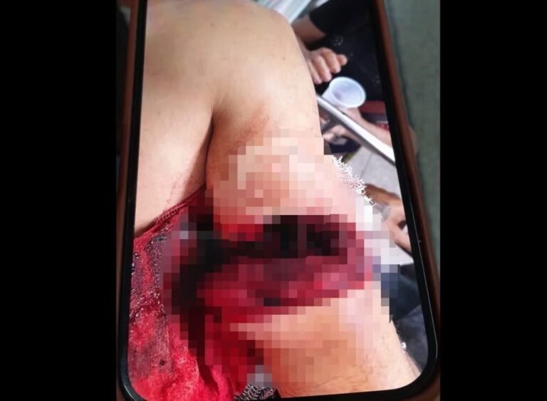 Após dar carona para mulher, homem é atacado com facão e fica gravemente ferido no interior do Acre