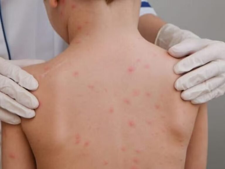 Casos de meningite caem 35% no Acre em 2026, aponta Sesacre