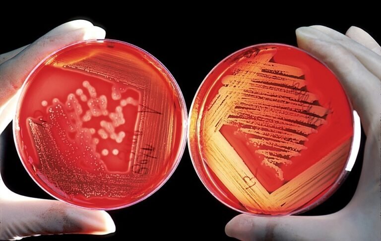 Sesacre confirma 13 casos de meningite e uma morte no Acre em 2026